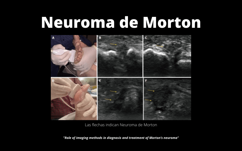 Neuroma Morton 1.png